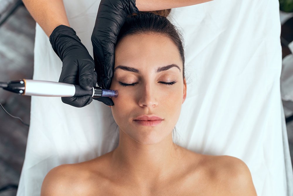 microneedling in london