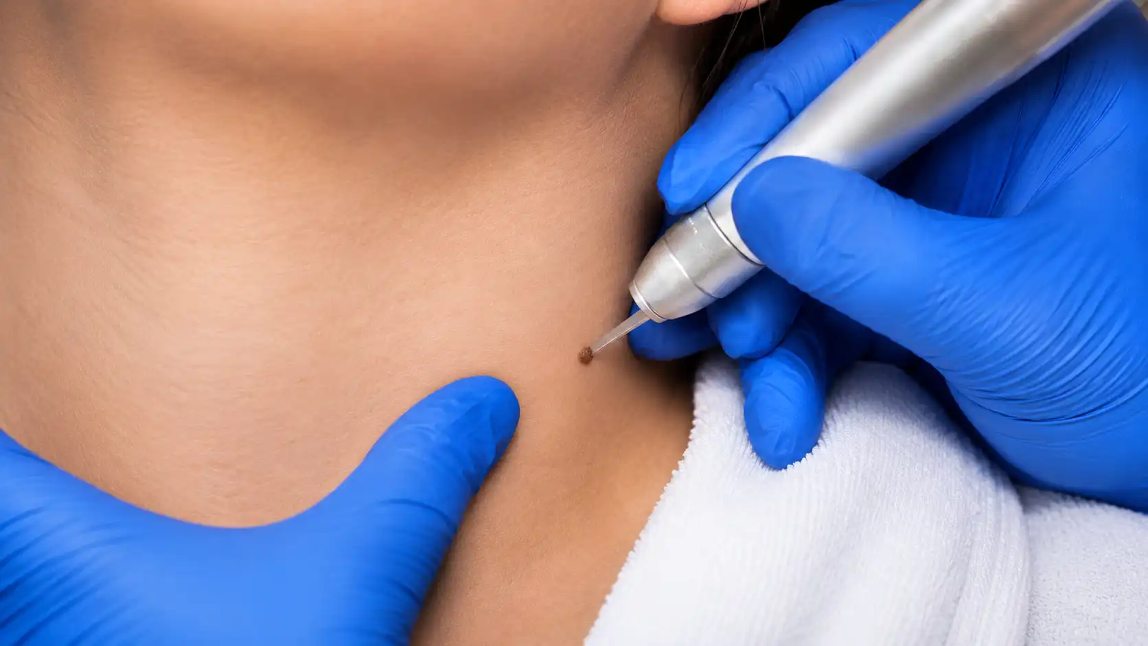 Thinking About Cryotherapy on Skin Tags?