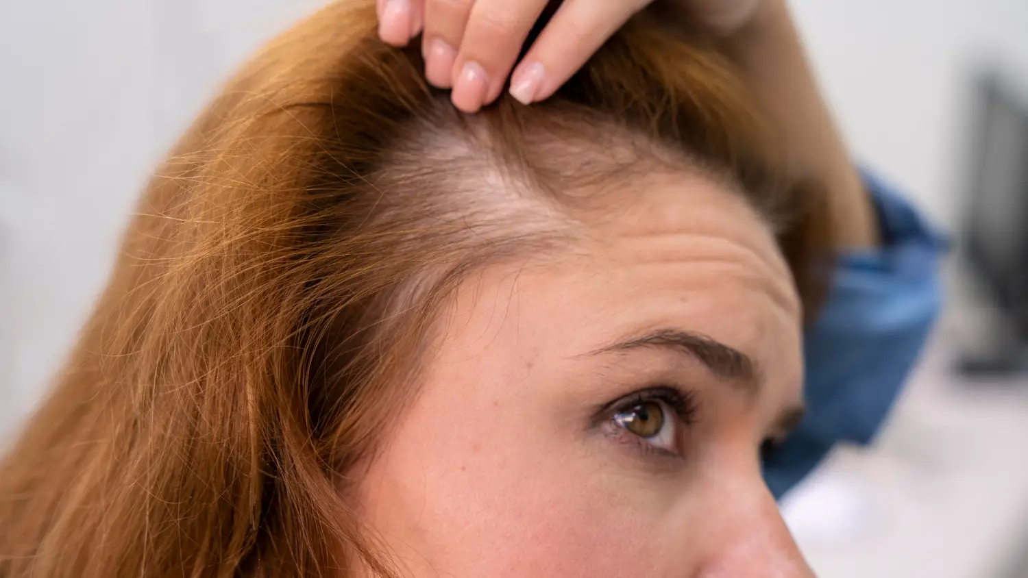 Is Hair Loss in Menopause Permanent, or Does It Grow Back